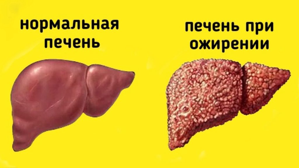 Народное лечение ожирение печени. Цирроз печени от ожирения.